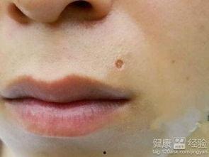 给吃瓜的男孩点痣视频播放,揭秘网红美容新潮流